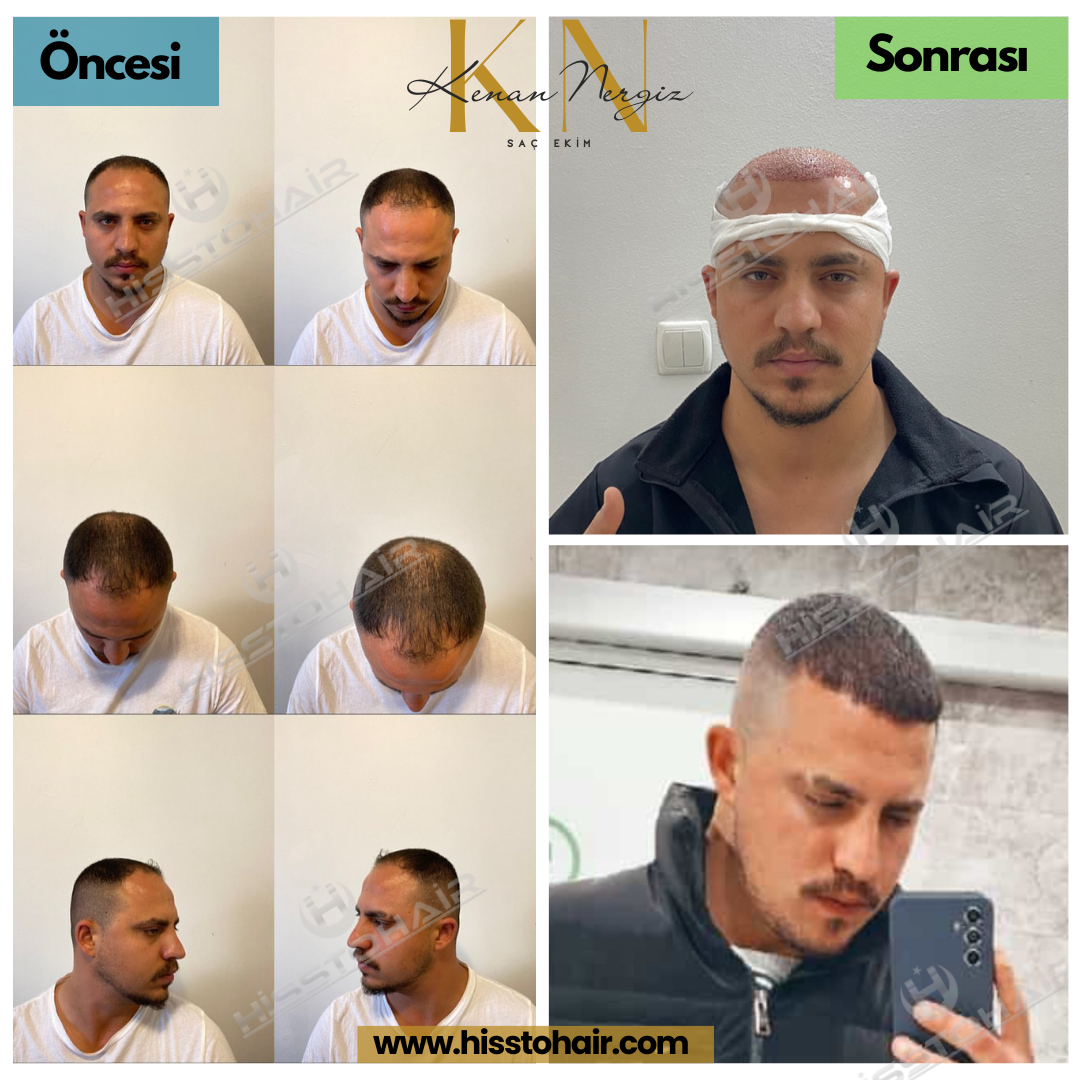 Bayındır Saç Ekim Merkezi