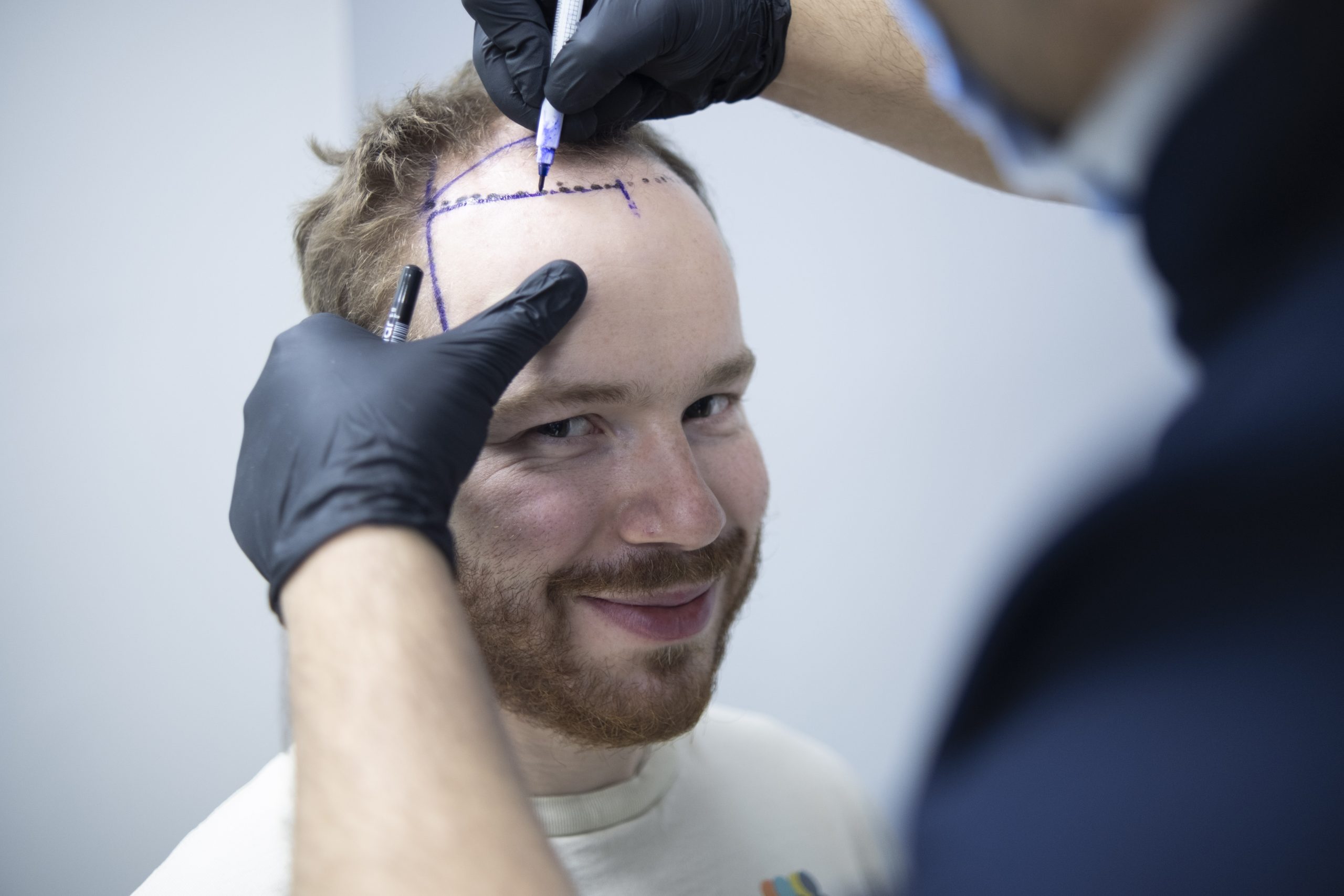 Edremit Saç Ekim Sonuçları - Saç Ekim Kliniği