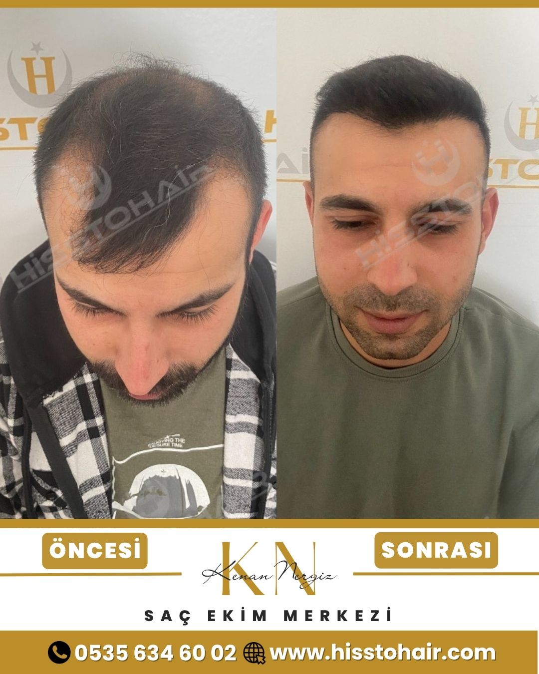 İzmir Aliağa Saç Ekim Sonuçları