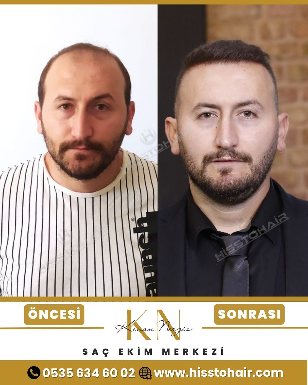 Edremit Saç Ekim Sonuçları - Saç Ekim Kliniği