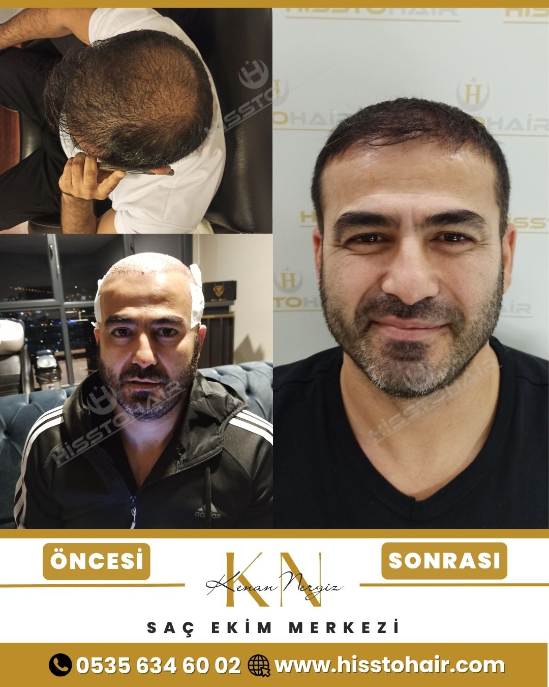 Edremit Saç Ekim Sonuçları - Saç Ekim Kliniği