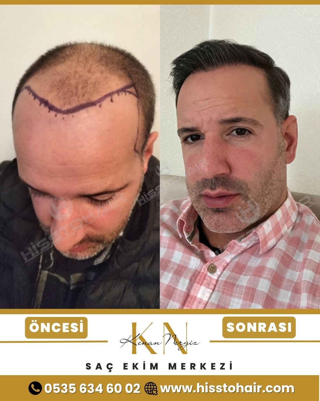 İzmir Aliağa Saç Ekim Sonuçları