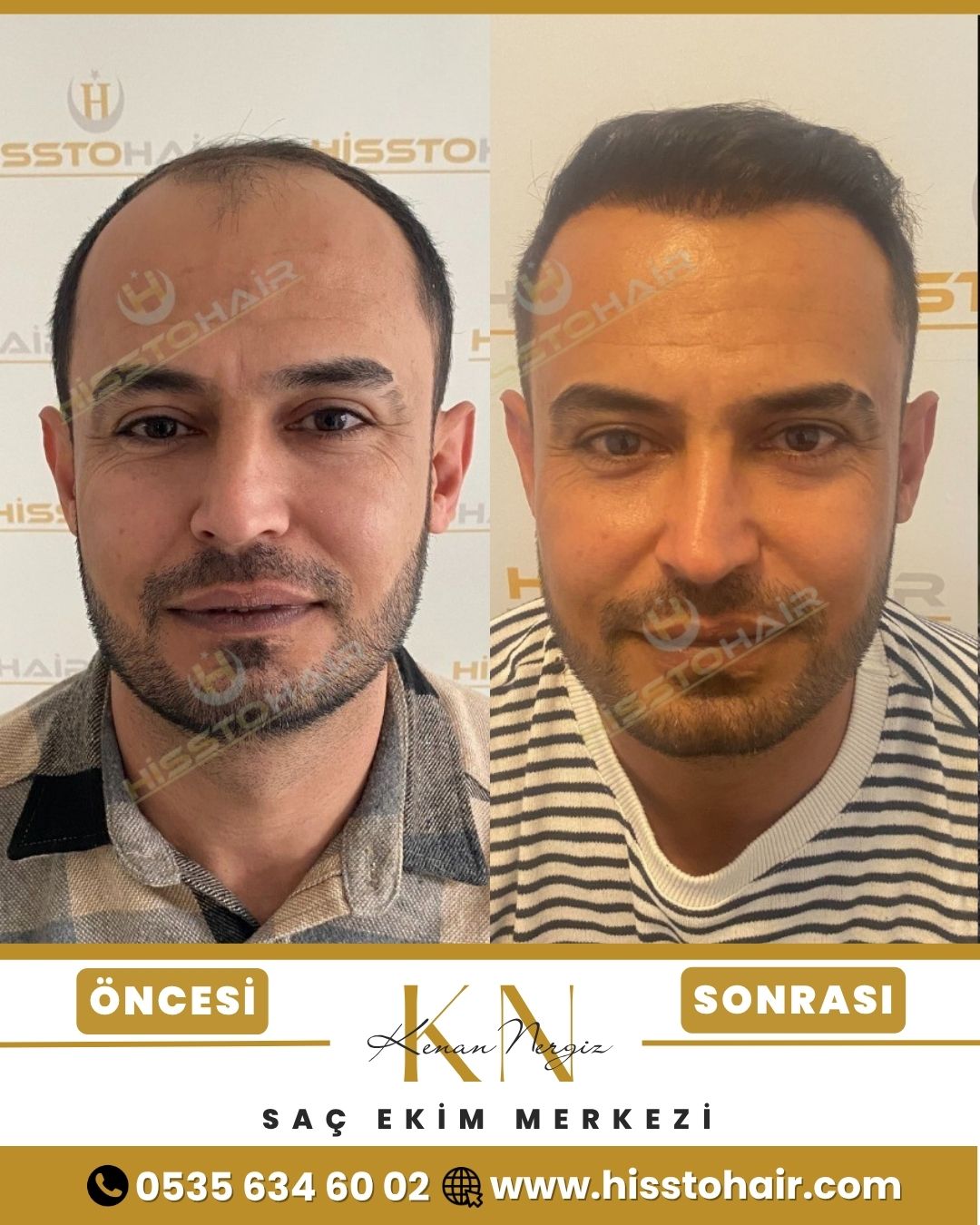 İzmir Aliağa Saç Ekim Sonuçları